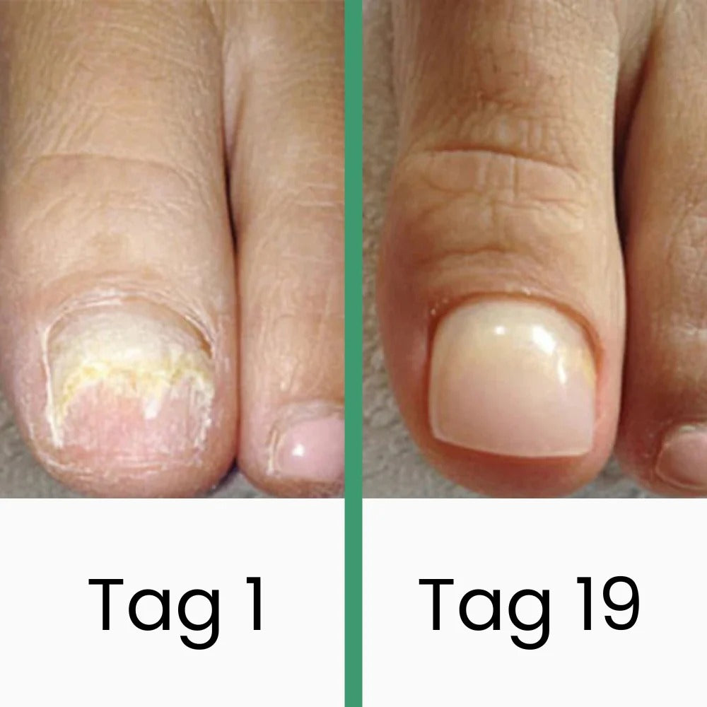 Coeurva LLLT-Nagelpilztherapie 👉nur wenige Sekunden täglich – heilt Pilzinfektionen vollständig, ganz ohne reizende Medikamente!