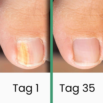 Coeurva LLLT-Nagelpilztherapie 👉nur wenige Sekunden täglich – heilt Pilzinfektionen vollständig, ganz ohne reizende Medikamente!