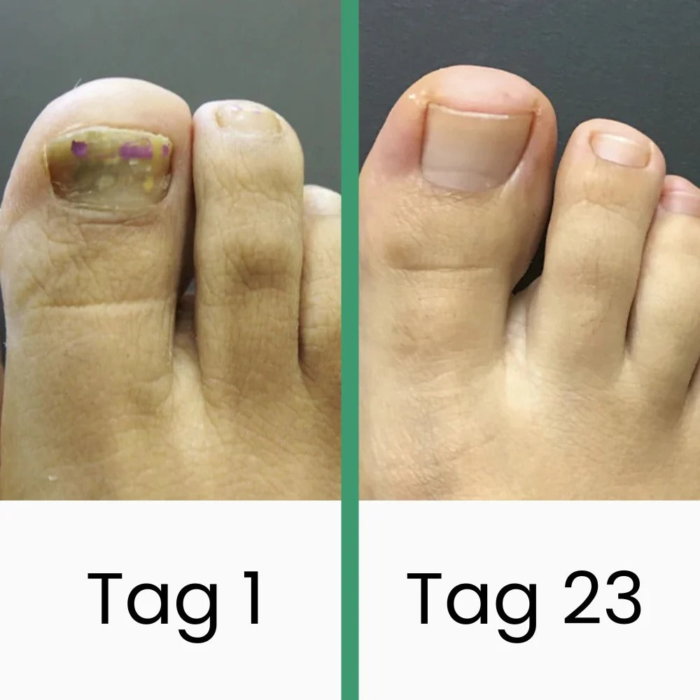 Coeurva LLLT-Nagelpilztherapie 👉nur wenige Sekunden täglich – heilt Pilzinfektionen vollständig, ganz ohne reizende Medikamente!